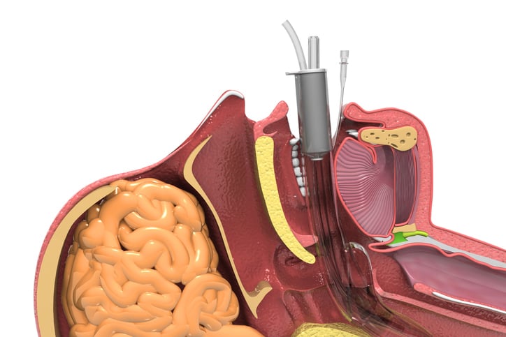 6 Suction Catheter Uses